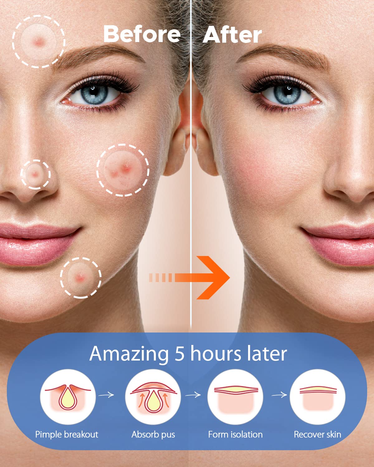 LitBear parches acne dia 14mm: cobertura rápida y discreta