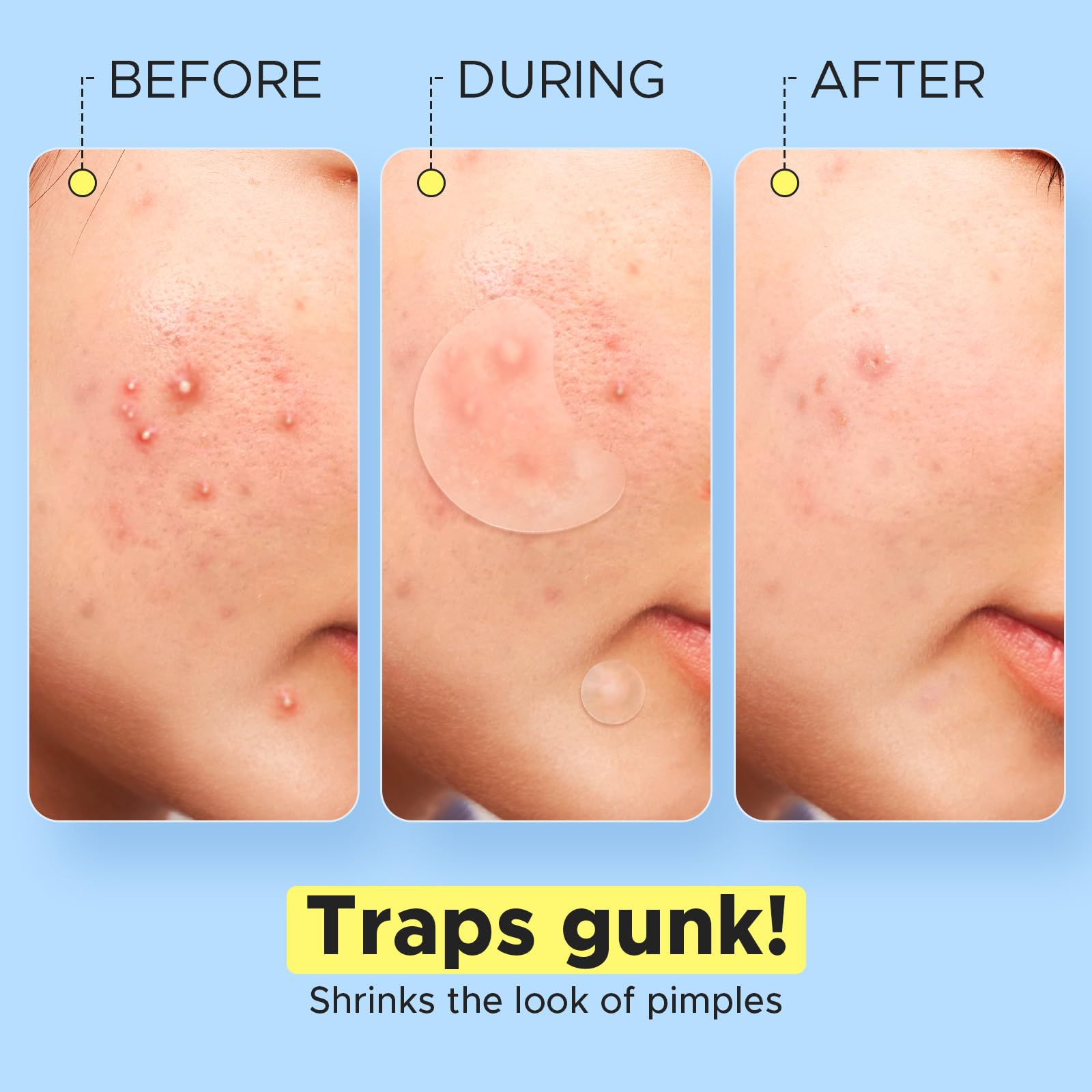 LitBear Pimple Patches on the back application near a shoulder blade