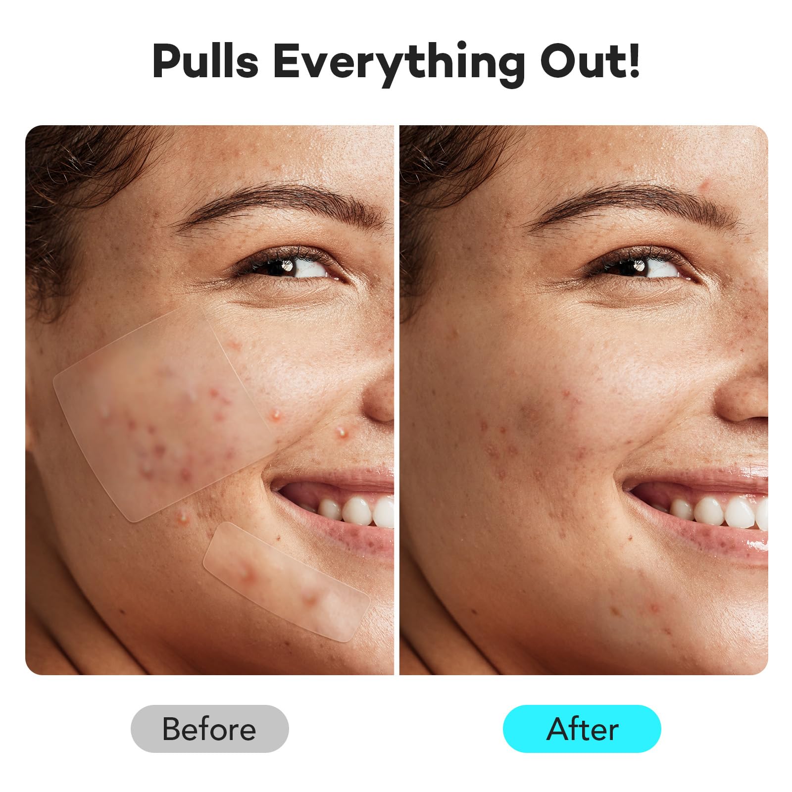 LitBear pimple patches dots shape for precise placement on tiny blemishes