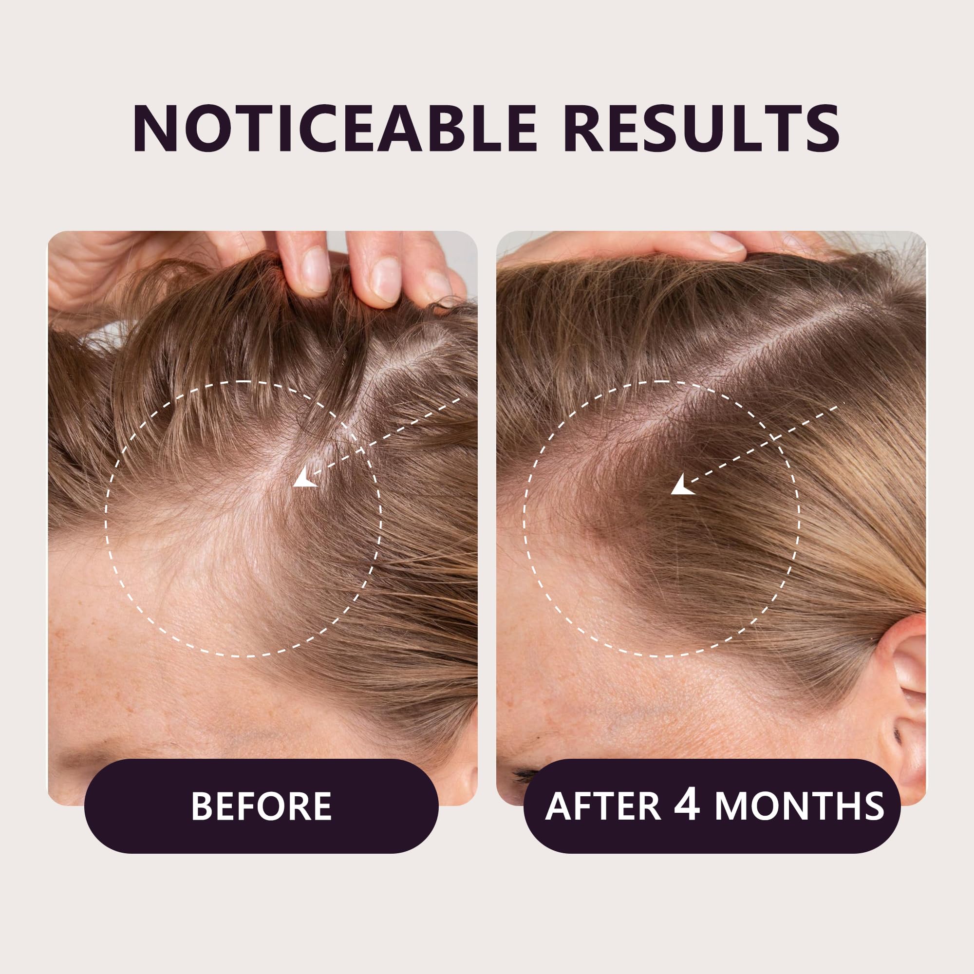 The LONGCCI 0.25mm derma roller is included for gentle scalp care.