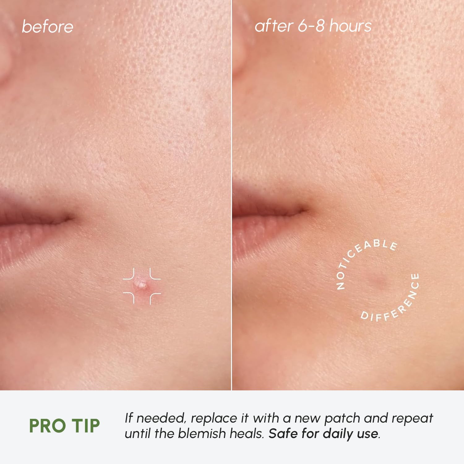 MAREE overnight pimple patches protect and calm skin while you sleep