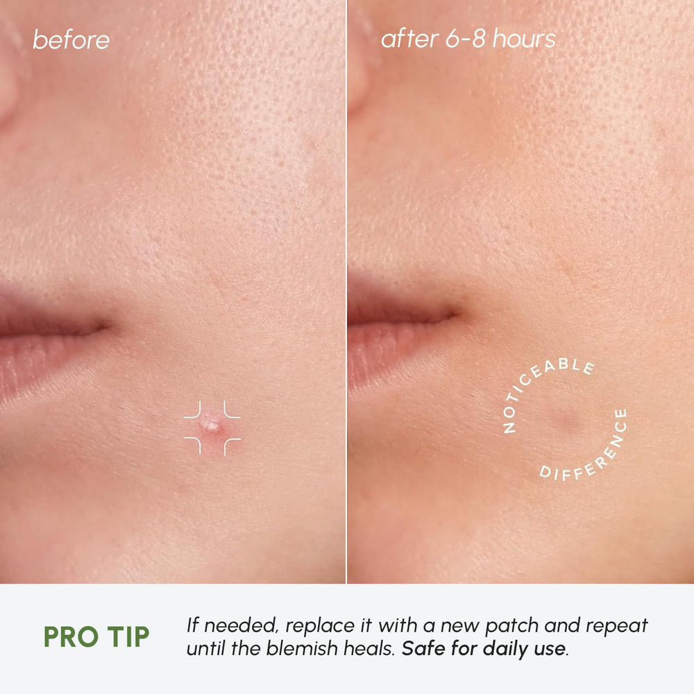 MAREE overnight pimple patches protect and calm skin while you sleep