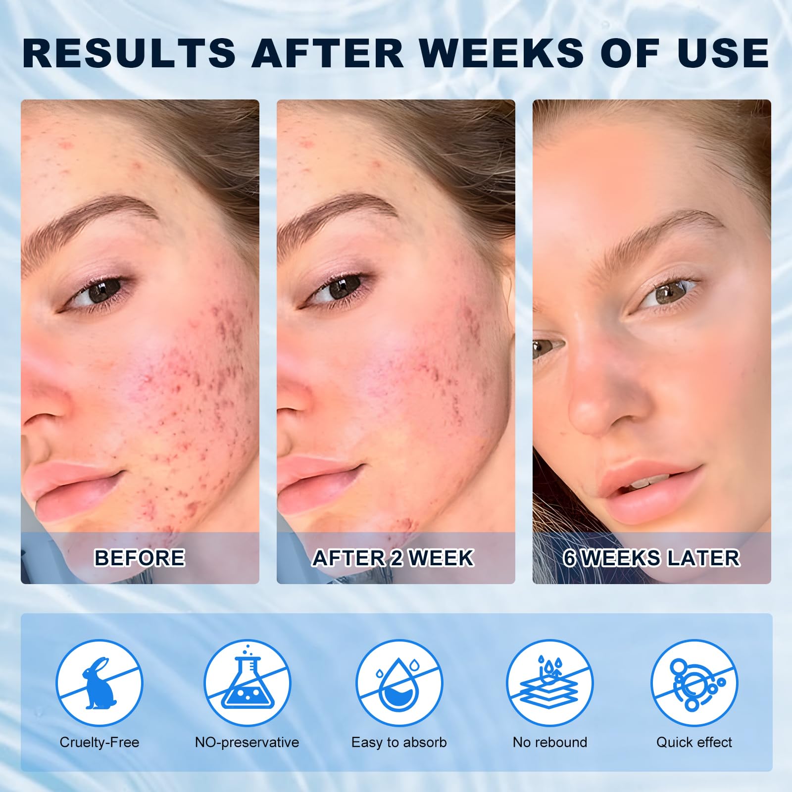 Marianp Azelaico 10% crema rostro ayuda a reducir enrojecimiento