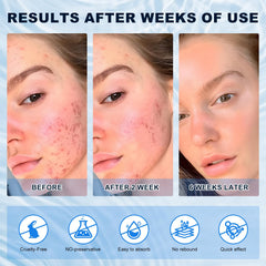 Marianp Azelaico 10% crema rostro ayuda a reducir enrojecimiento