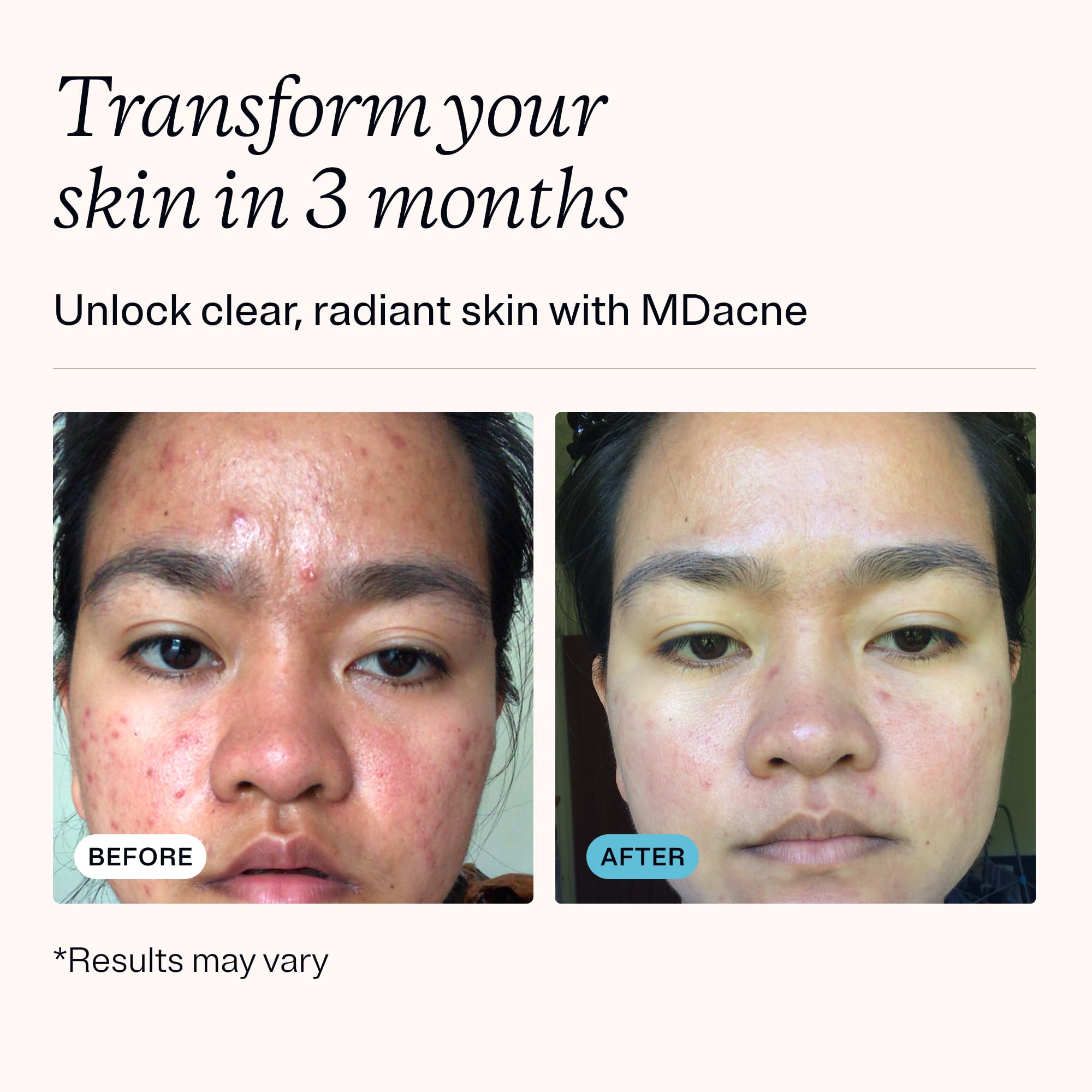 MDacne salicylic acid cleanser cleanses pores without drying.