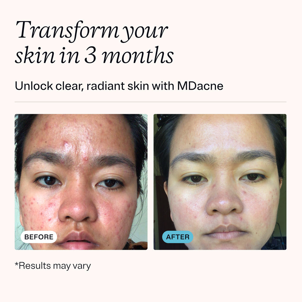 MDacne salicylic acid cleanser cleanses pores without drying.