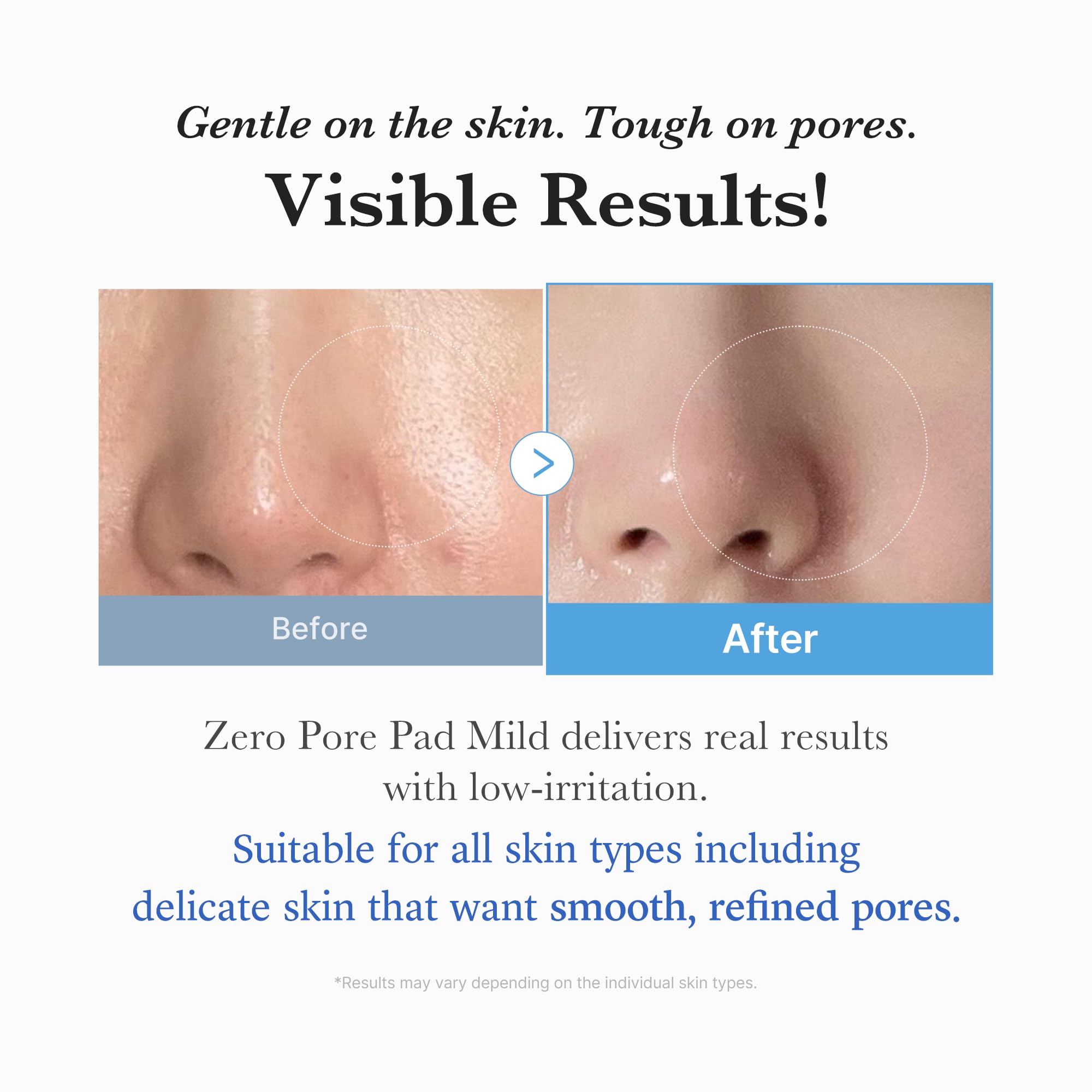 Medicube Zero Pore Pad Mild 2.0 pores before-after demonstrates refinement.