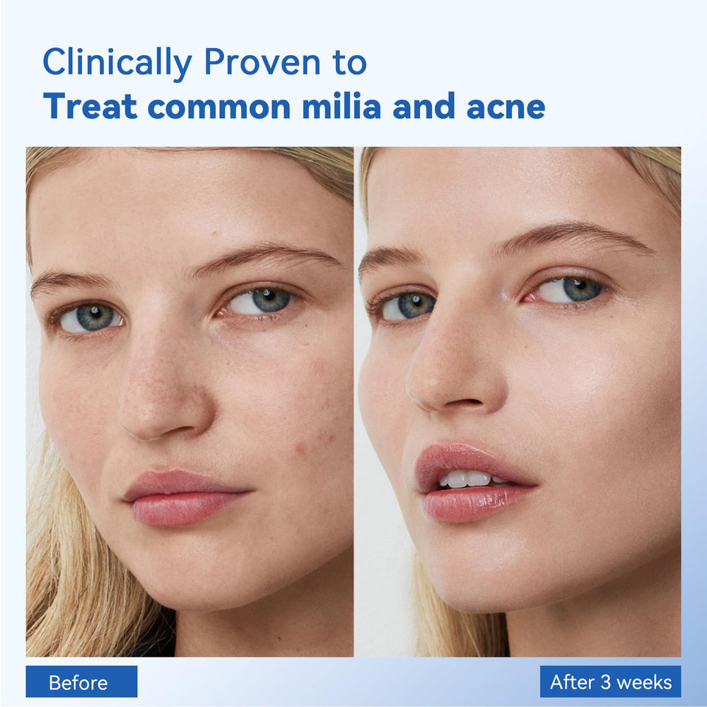 MEOLY Milia Remover, aplicación en mejillas y nariz para tratamiento puntual.