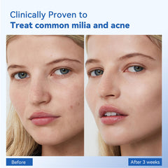 MEOLY Milia Remover, aplicación en mejillas y nariz para tratamiento puntual.