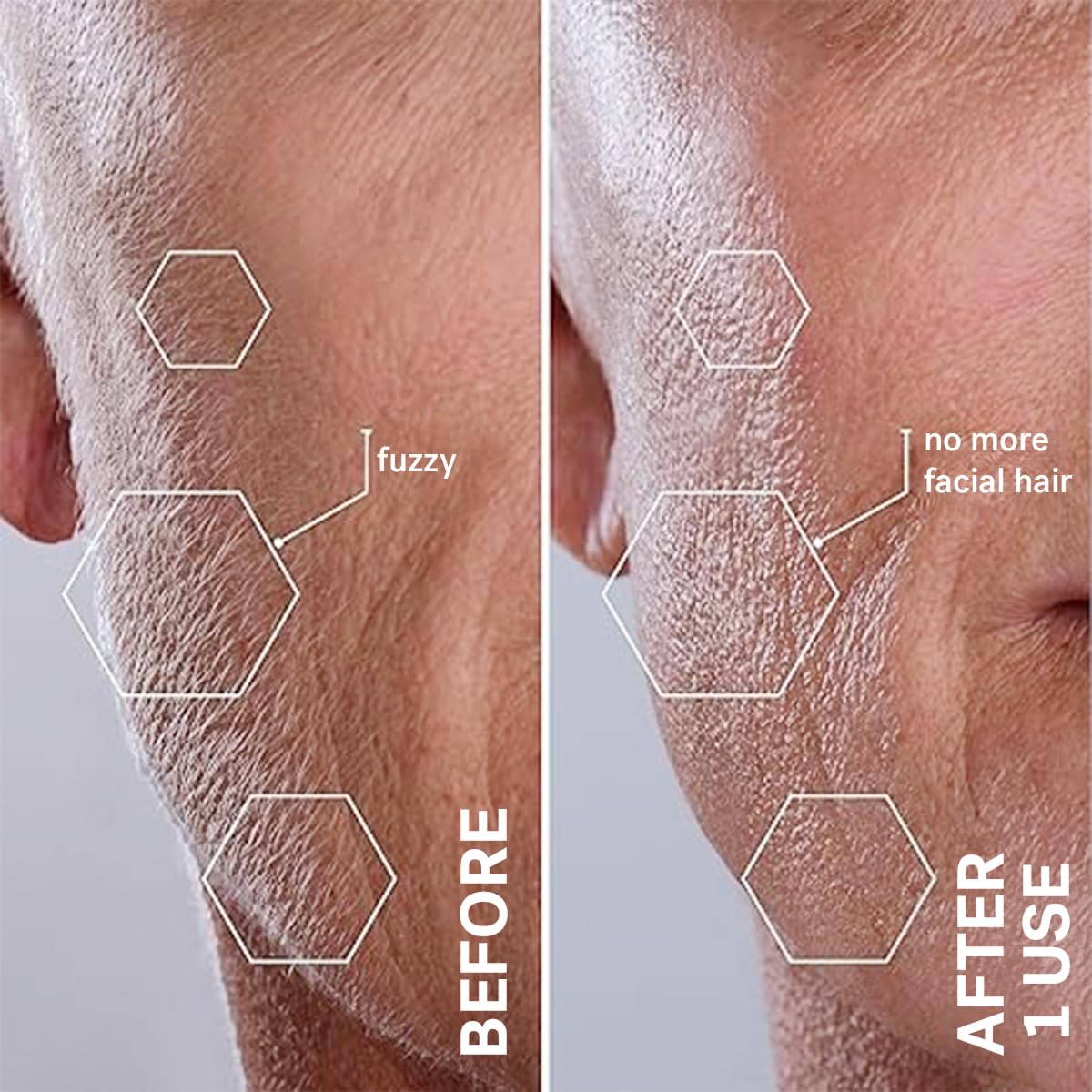 Michael Todd Sonicsmooth safety edges close-up highlighting skin-safe dermaplaning