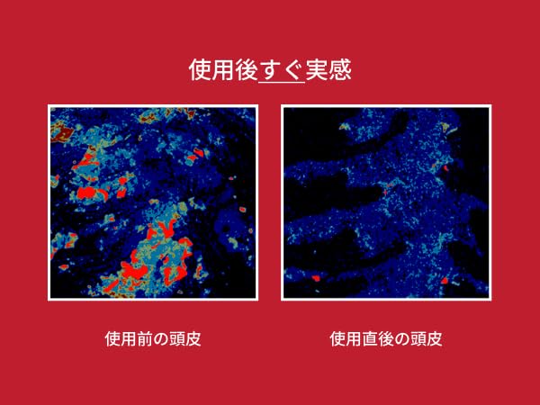 MOEV ANNURCATIN limpieza suave del cuero cabelludo