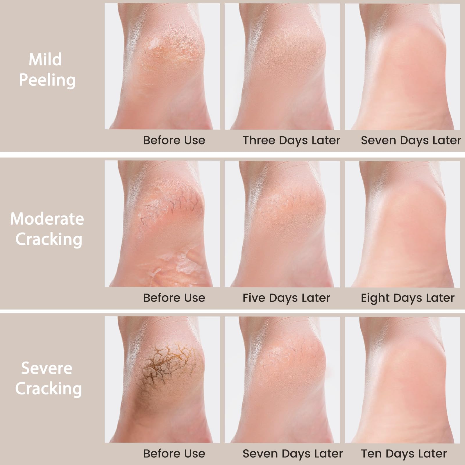 Mouriven Urea Cream 40% non-greasy formula absorbs quickly