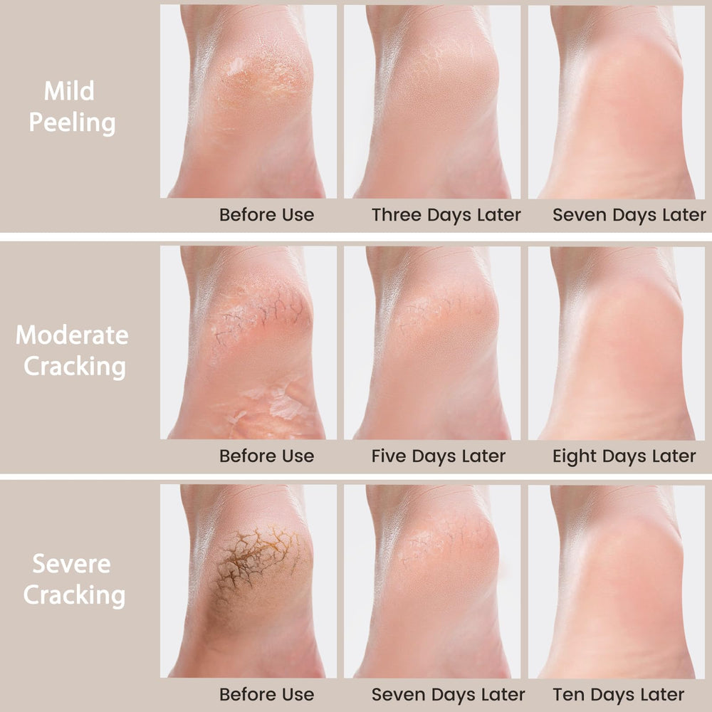 Mouriven Urea Cream 40% non-greasy formula absorbs quickly