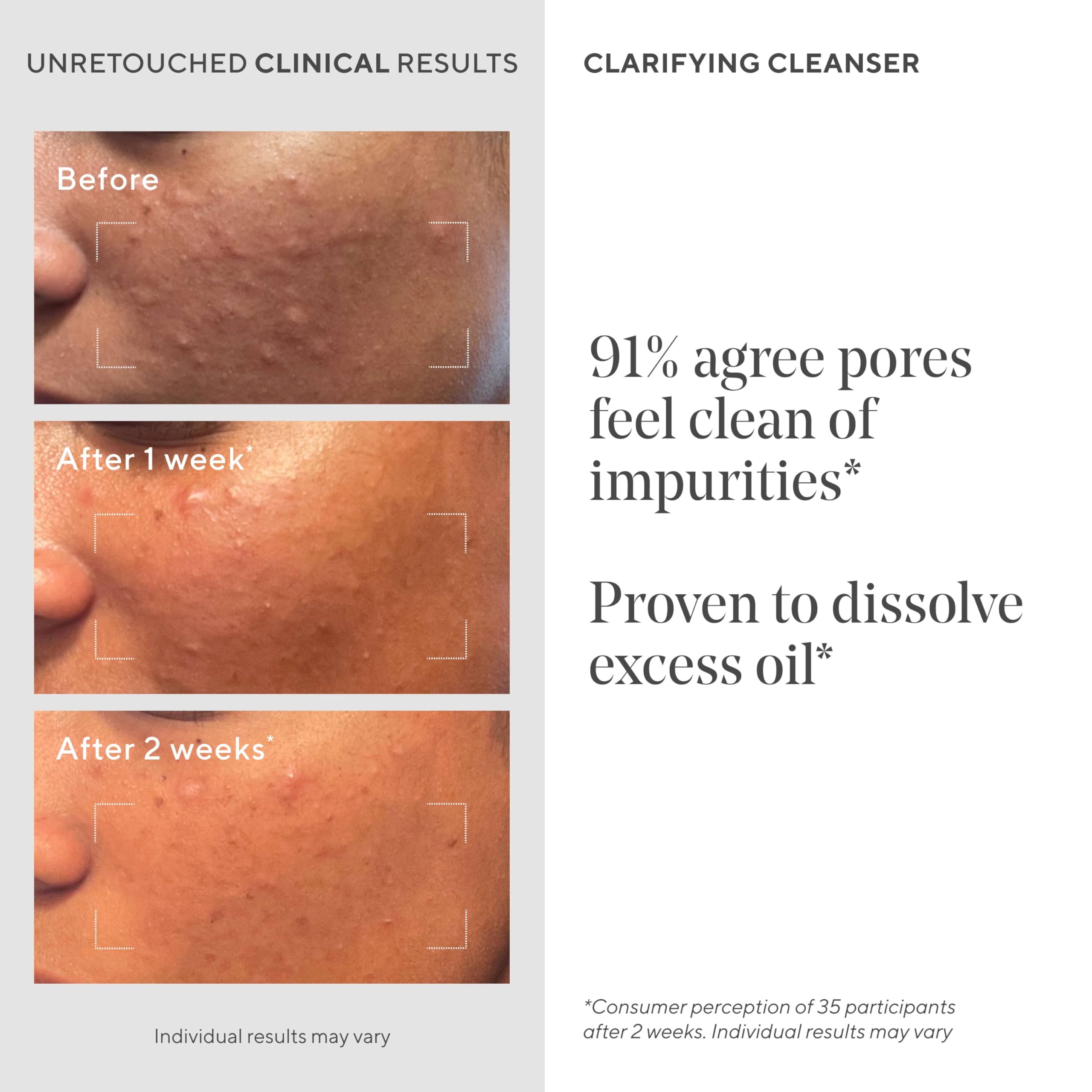 Murad Acne Control Clarifying Cleanser gel texture applied on skin.