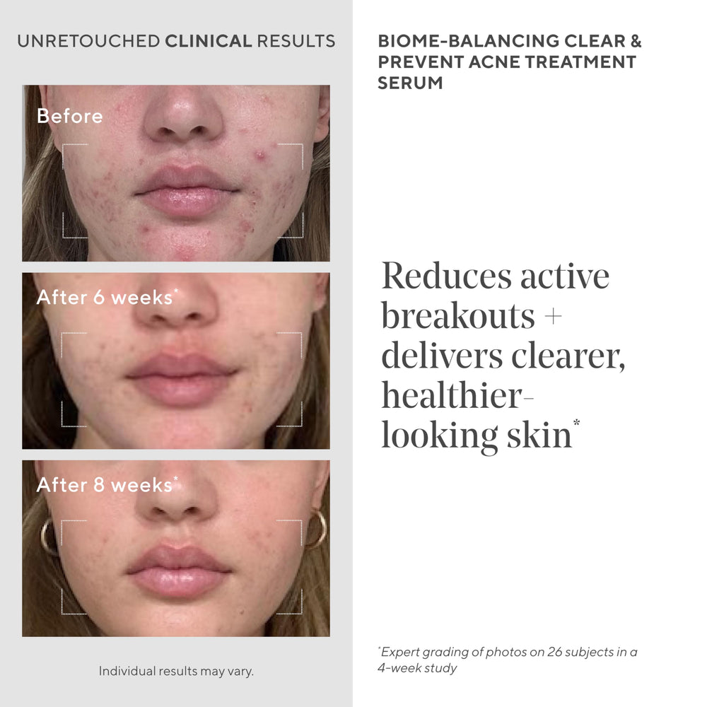 Murad Acne Trial Kit close-up shows premium textures for cleanser and spot-treatment.