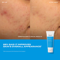 Murad Acne Trial Kit oil-control mattifier highlighted for shine reduction.
