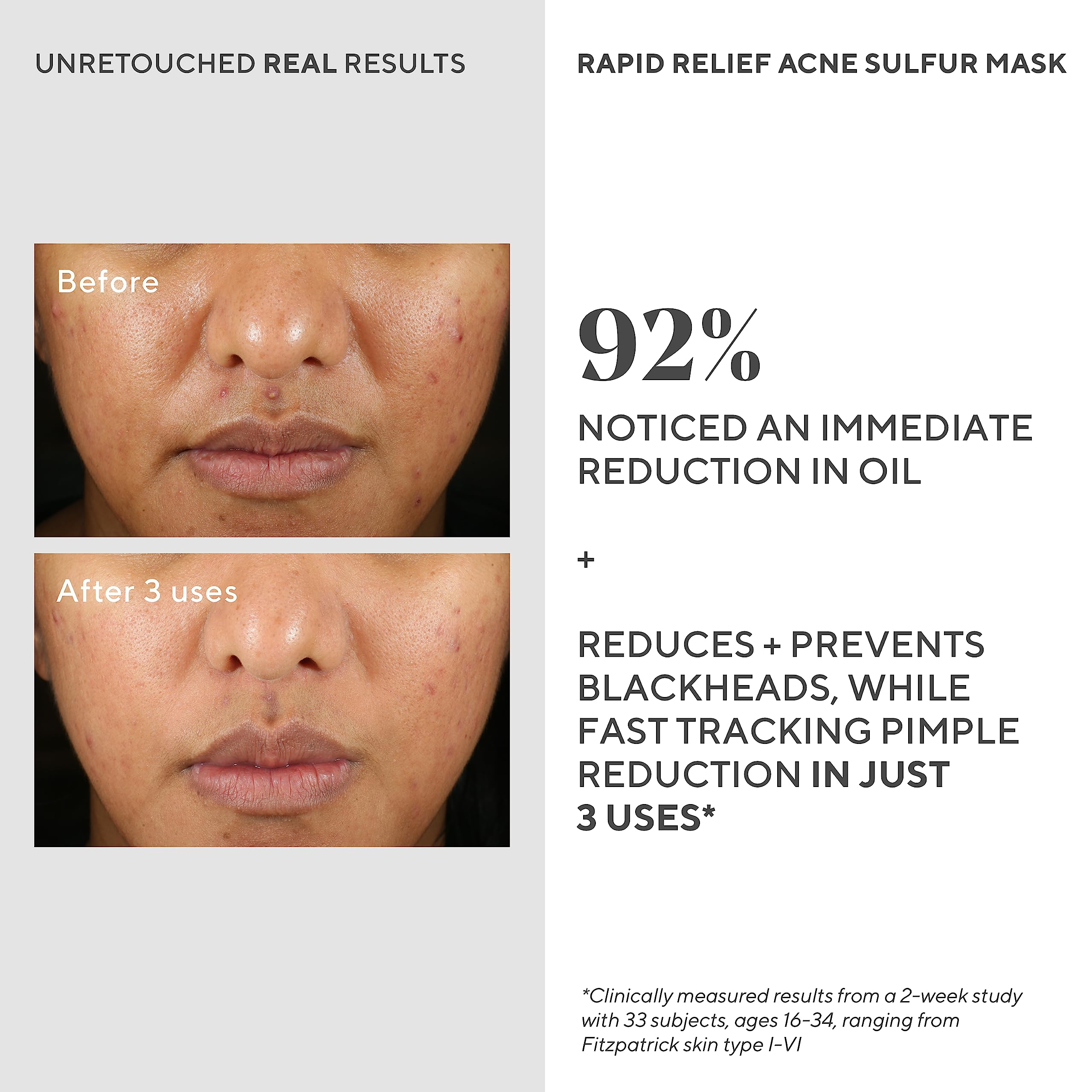 Mask drying on skin after 10-15 minutes