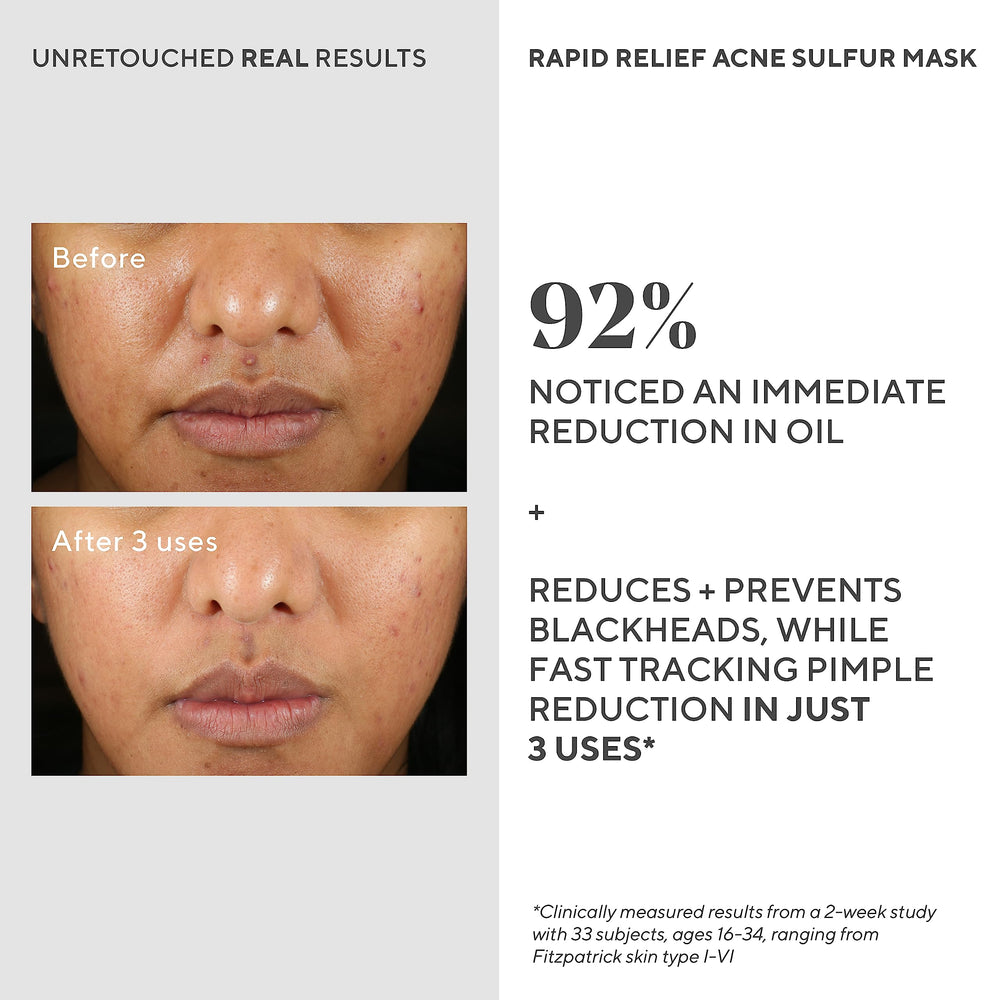 Mask drying on skin after 10-15 minutes