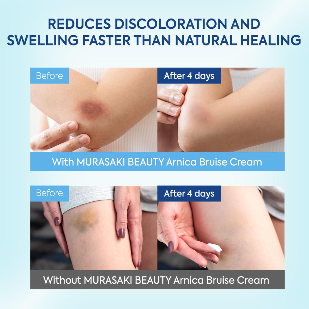 MURASAKI BEAUTY Arnica Bruise Cream on arm demonstrates targeted relief for bruising
