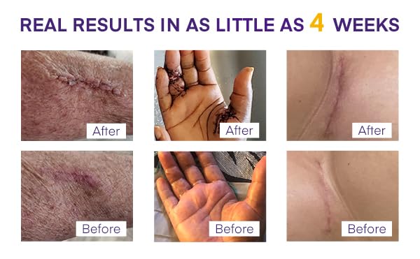 MURASAKI BEAUTY silicone scar gel supports long term scar smoothness