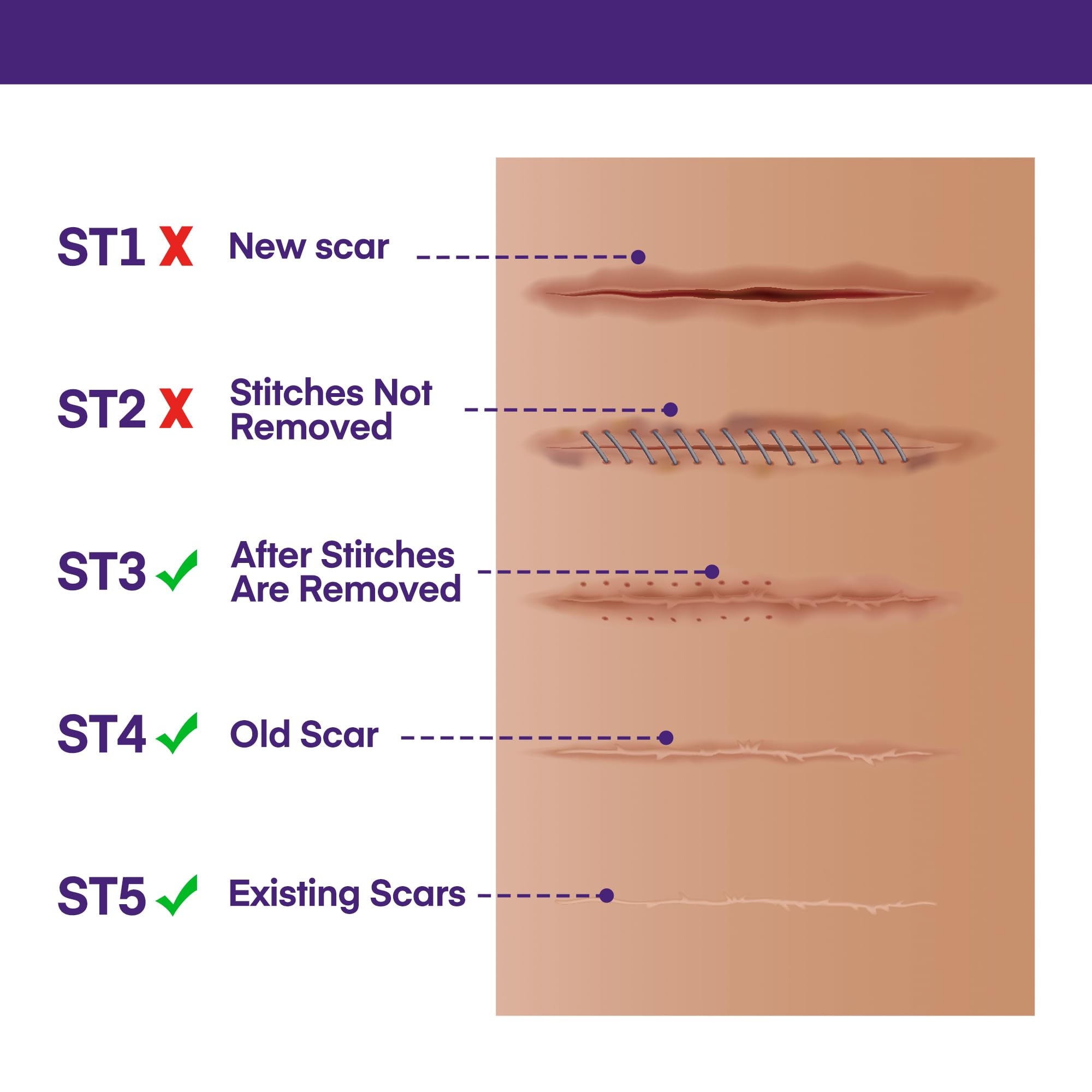 MURASAKI BEAUTY scar gel dispenser for precise application
