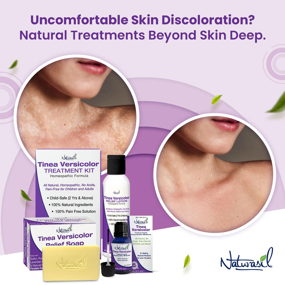 Naturasil Tinea Versicolor soap bar side angle showing texture and natural botanicals for skin support.