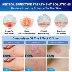 Nedtol Folliculitis Treatment Cream targeting itchy follicles
