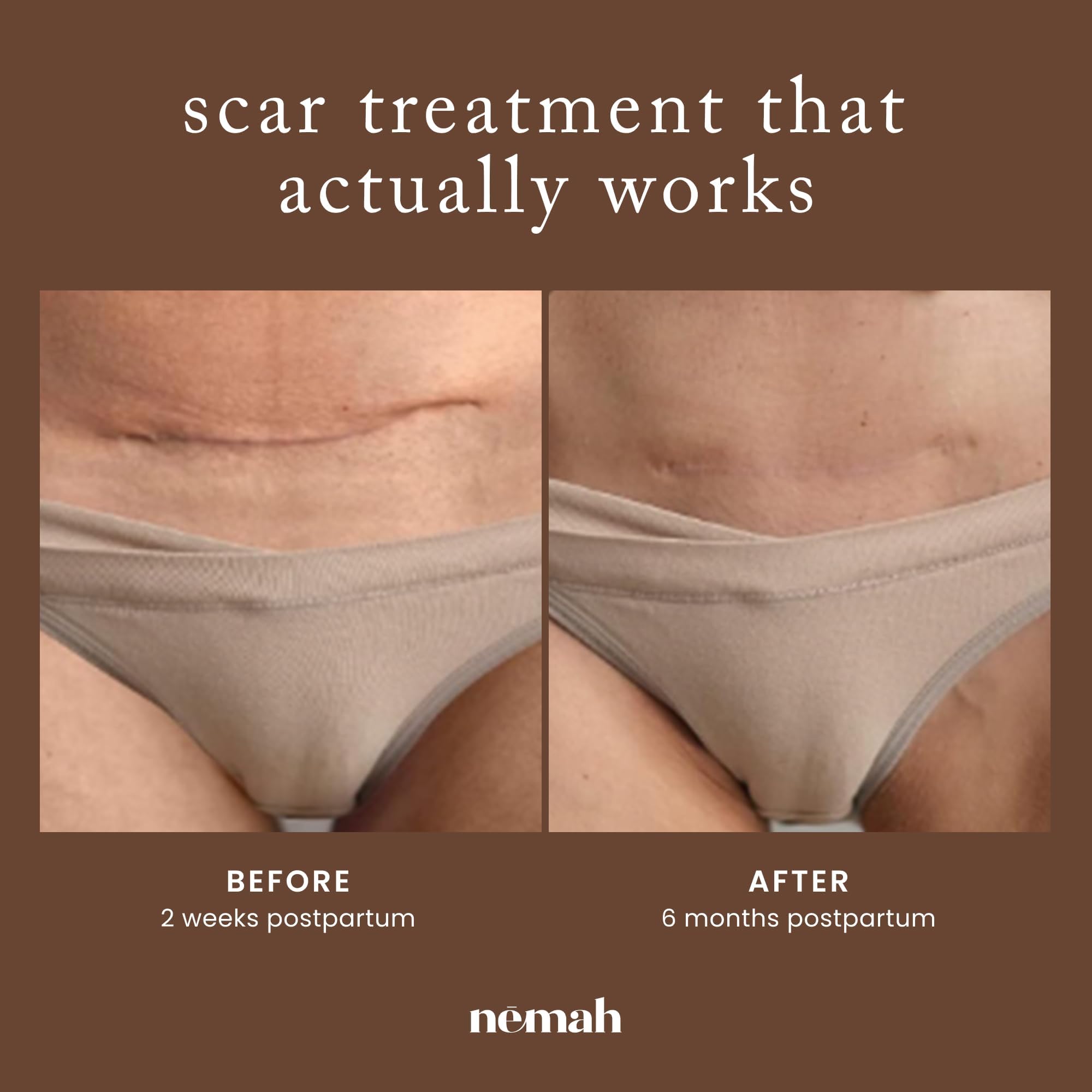 Close-up of Nemah Restorative Scar Treatment improving scar appearance over time.