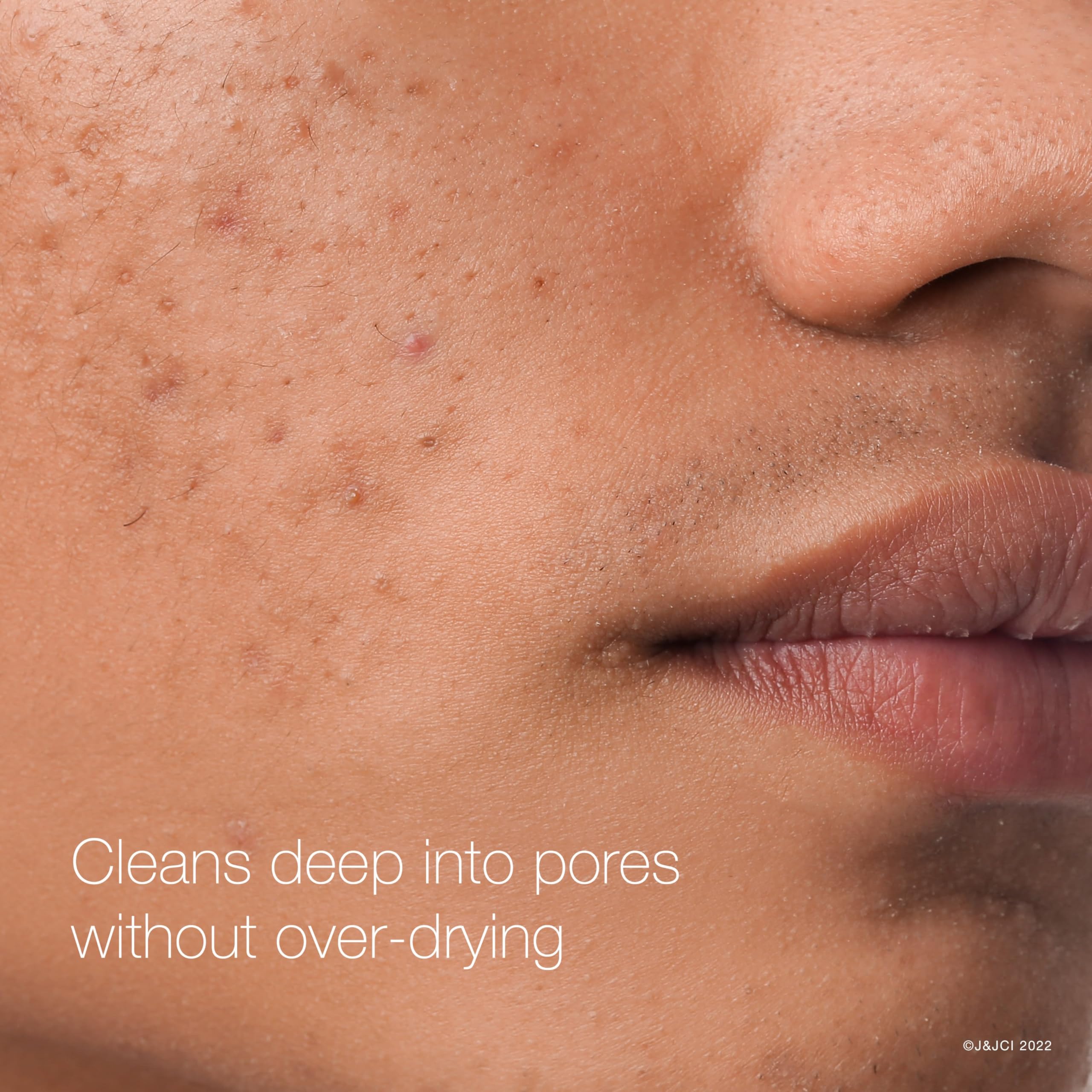 Neutrogena Rapid Clear pads close-up with 2% salicylic acid for oil-control