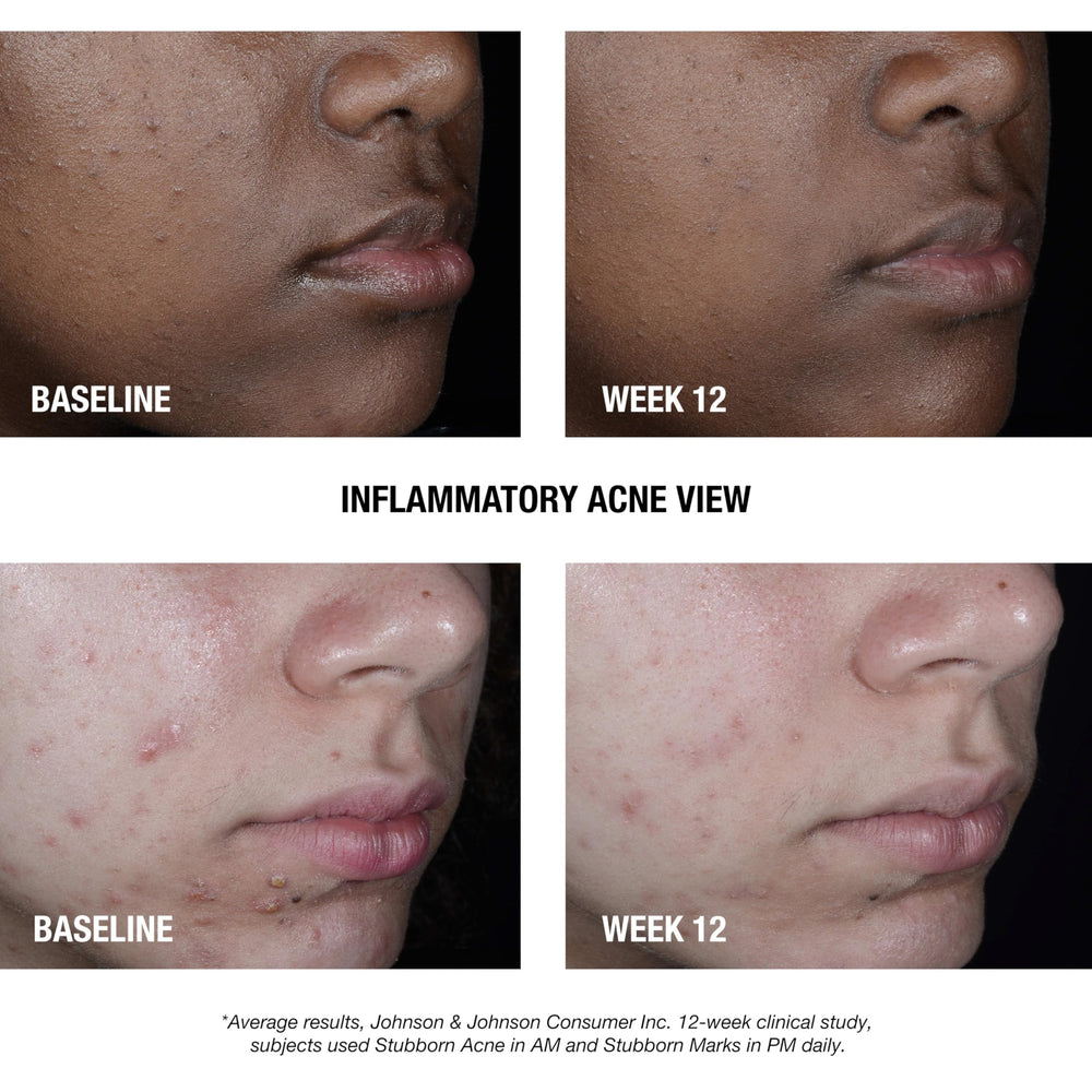 Aplicación diaria suave de Neutrogena tratamiento diurno en la piel