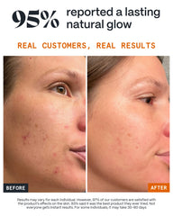 Norse Organics Pimple Stopper on face application shows fast absorbing daytime use