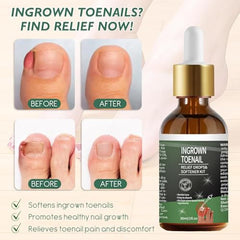 NWAKRD applicator for toenail treatment ensures precise at-home application.
