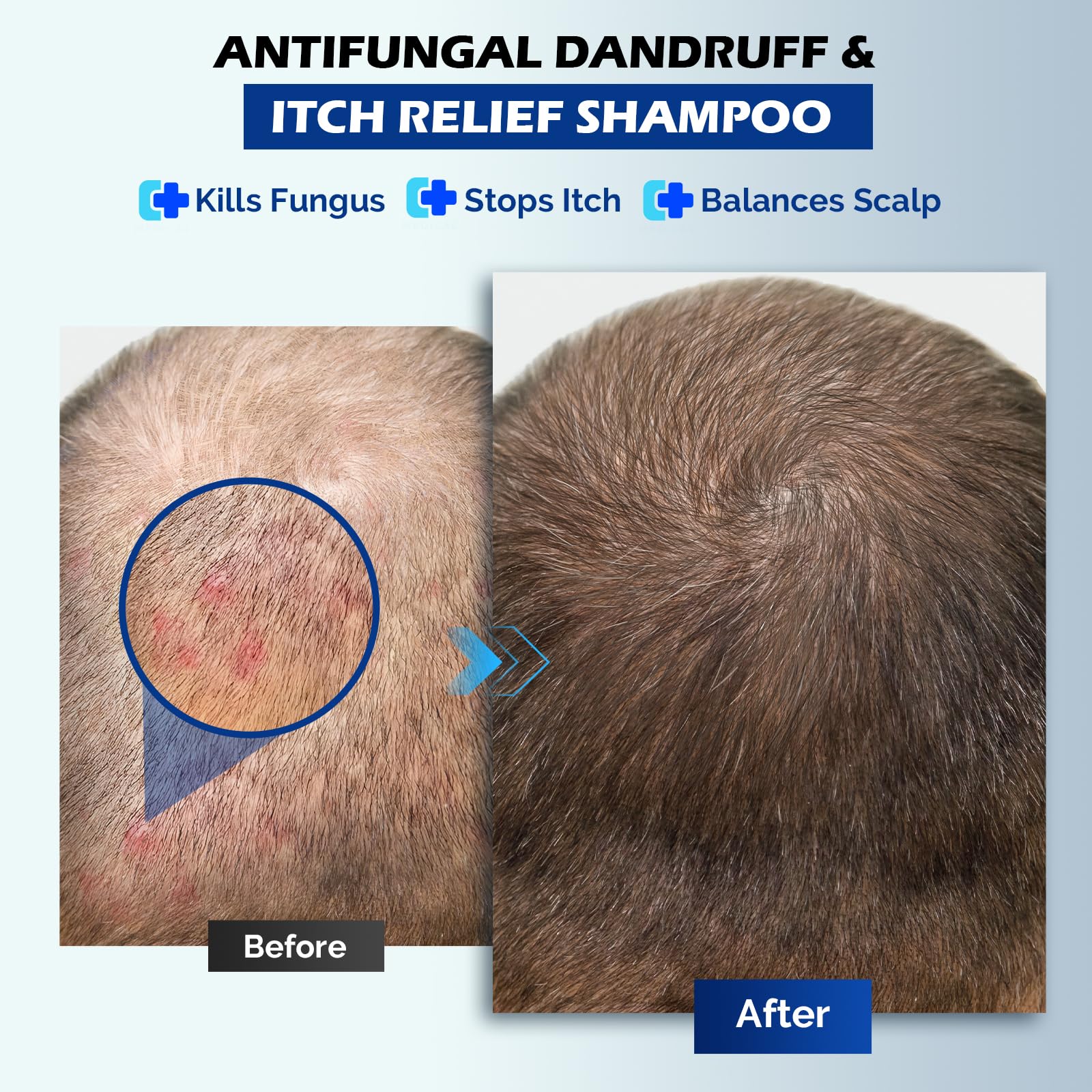 Oely antifungal shampoo application on scalp illustrating direct treatment at the root