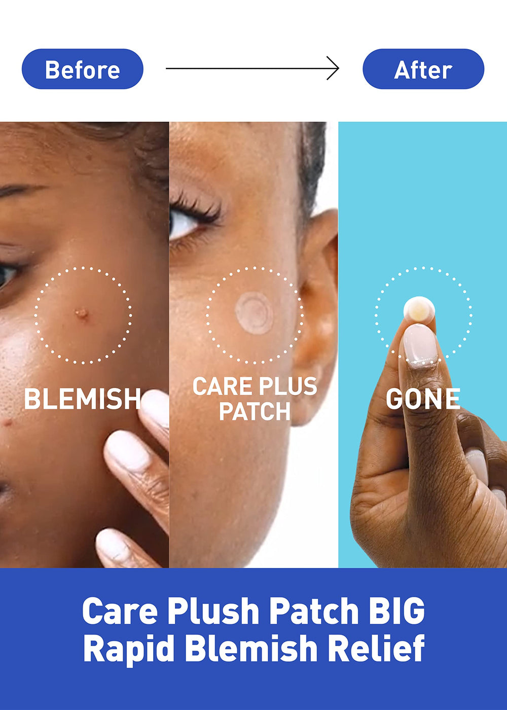 OLIVE YOUNG Care Plus Spot Patch colocado sobre imperfección para cobertura discreta.
