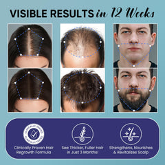 OLIVITA Minoxidil ayuda a cabello más grueso y denso.