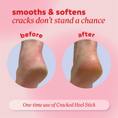 Onyx Professional cracked heel treatment addressing rough skin