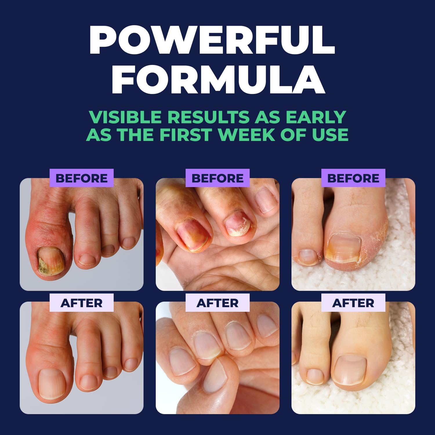 Orivelle Nail Fungus Pen packaging shown for easy storage.