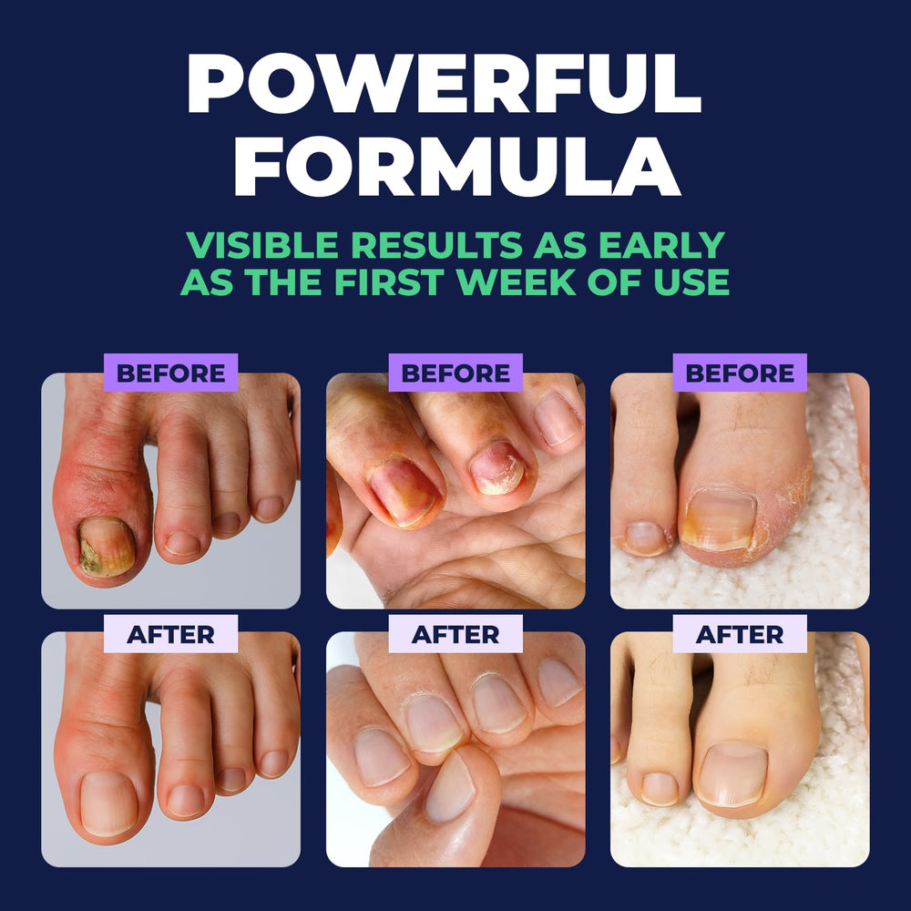 Orivelle Nail Fungus Pen packaging shown for easy storage.