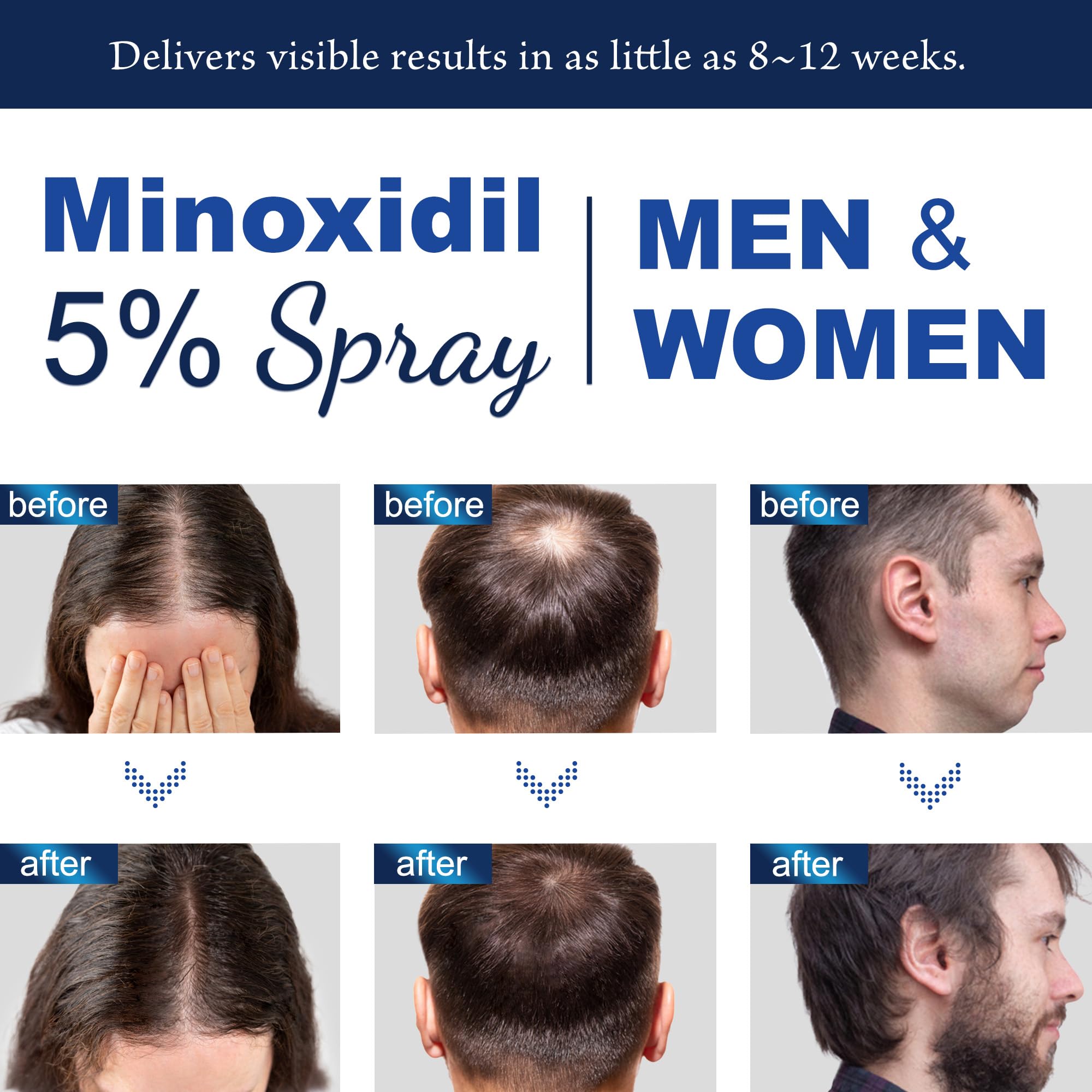 OSIMOON Minoxidil 5% spray label close-up showing Biotin and Hydrolyzed Collagen