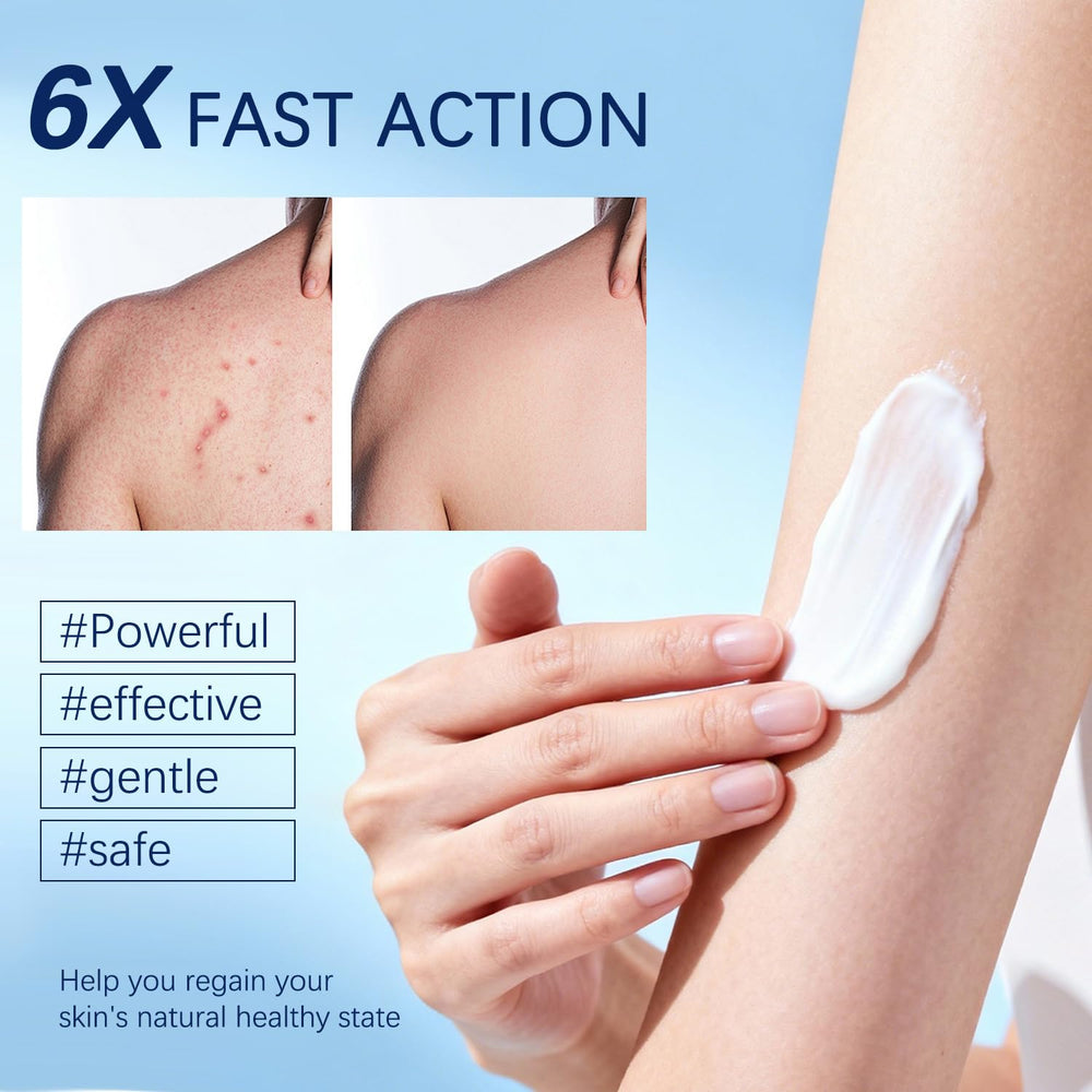 OUHENGTEK Crema Foliculitis, adecuado para uso en el cuero cabelludo tras la limpieza