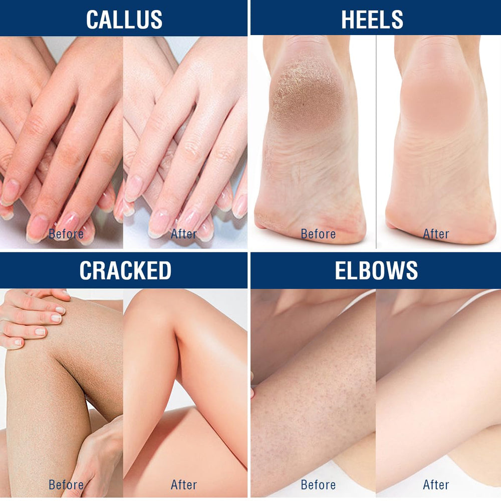 OUKEYA Urea Cream 40% daily-use product for smooth skin.