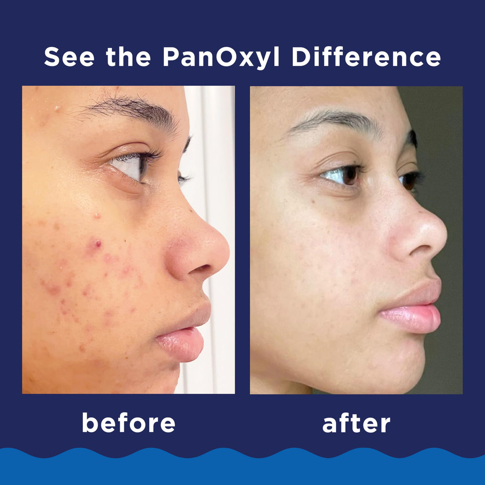 PanOxyl espuma para acné en la espalda, limpia poros y reduce imperfecciones.