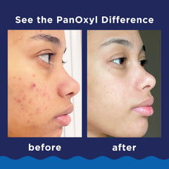 PanOxyl espuma para acné en la espalda, limpia poros y reduce imperfecciones.