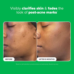 Paula's Choice Boost 10% Azelaic Acid Booster dropper dispensing a measured amount.