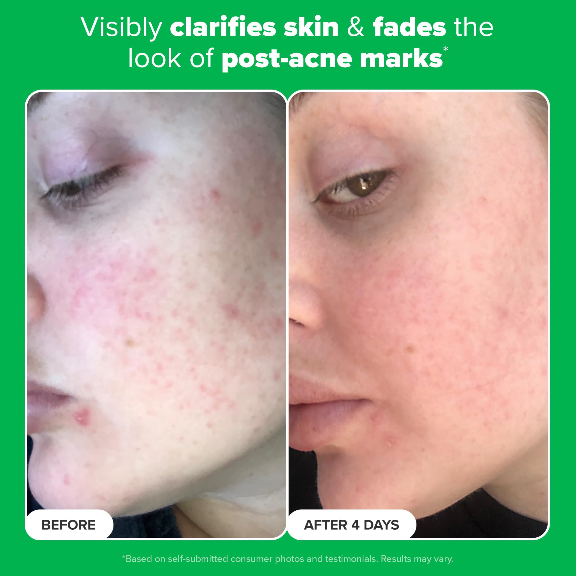 Paula's Choice Boost 10% Azelaic Acid Booster mixed with moisturizer for daily use.