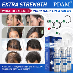 Pdam Minoxidil foam on scalp during application targets thinning areas