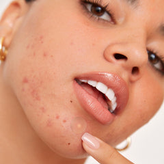 Peace Out Acne Healing Dots in daytime use to cover blemishes while going about your day.