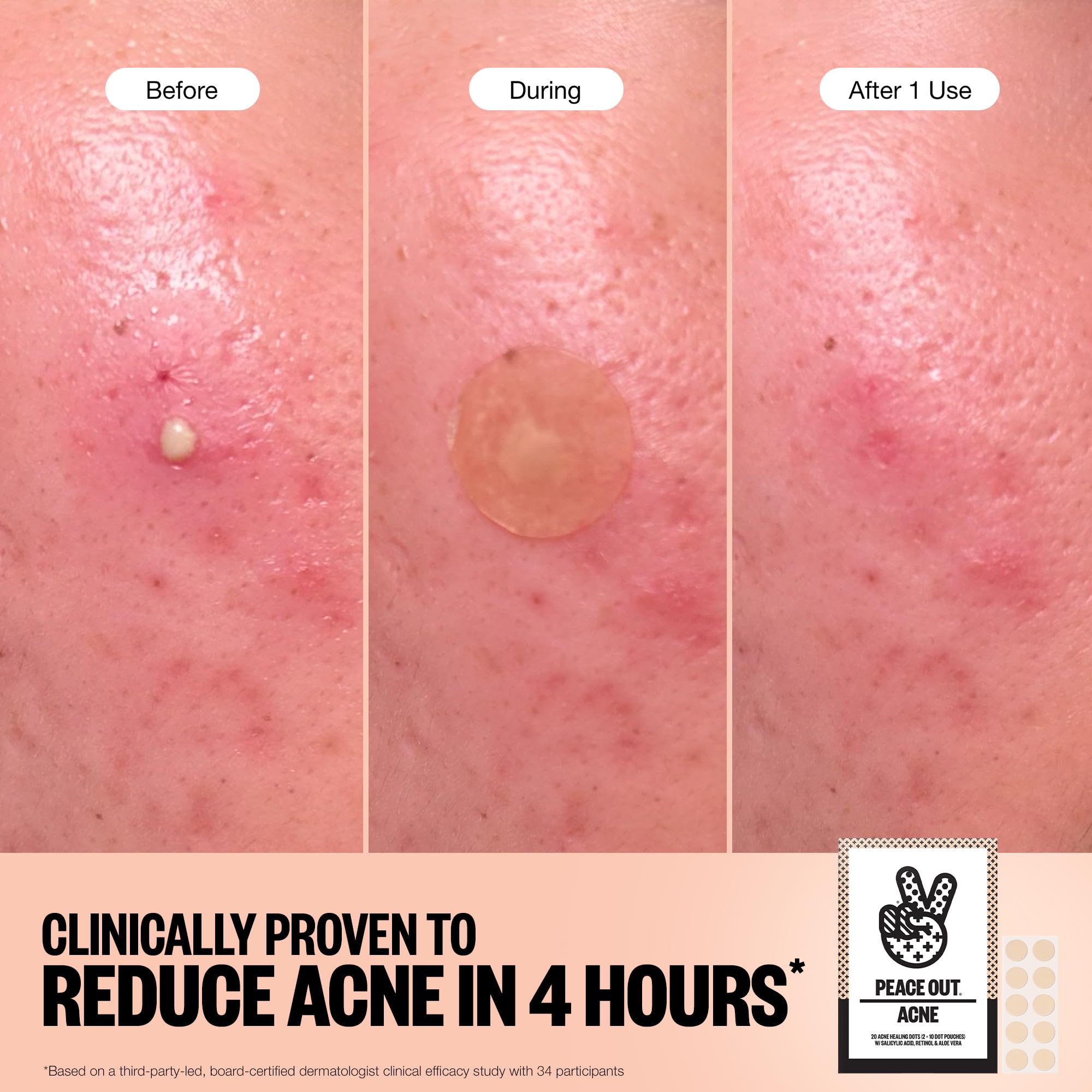 Peace Out Acne Healing Dots adhere smoothly to skin without tugging.