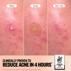 Peace Out Acne Healing Dots adhere smoothly to skin without tugging.
