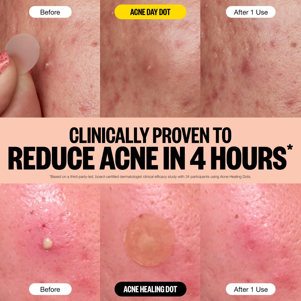 PEACE OUT Acne punto hidrocoloide impurezas: absorbe impurezas y protege la imperfección